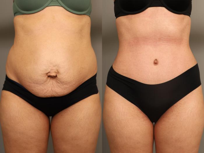 Before & After Tummy Tuck Case 324 Front View in New York, NY
