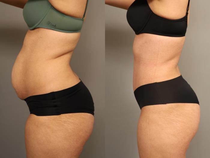Before & After Tummy Tuck Case 324 Left Oblique View in New York, NY