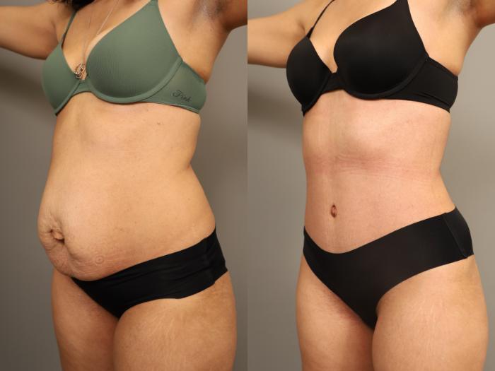 Before & After Tummy Tuck Case 324 Left Side View in New York, NY