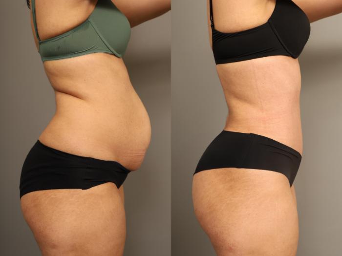 Before & After Tummy Tuck Case 324 Right Oblique View in New York, NY