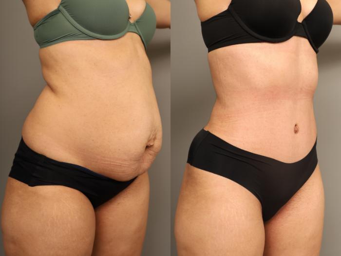 Before & After Tummy Tuck Case 324 Right Side View in New York, NY