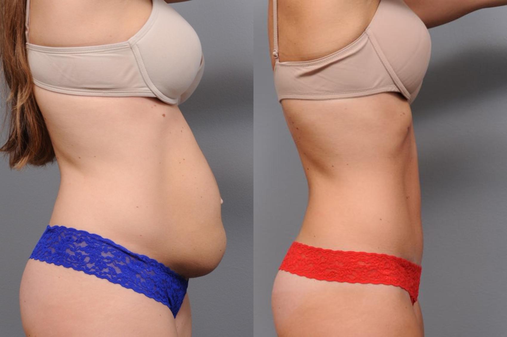 Before & After Tummy Tuck Case 64 View #1 View in New York, NY