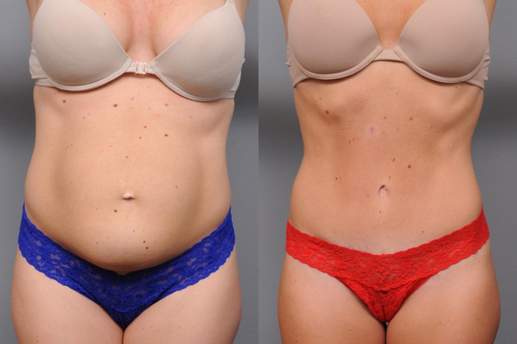 Before & After Tummy Tuck Case 64 View #2 View in New York, NY