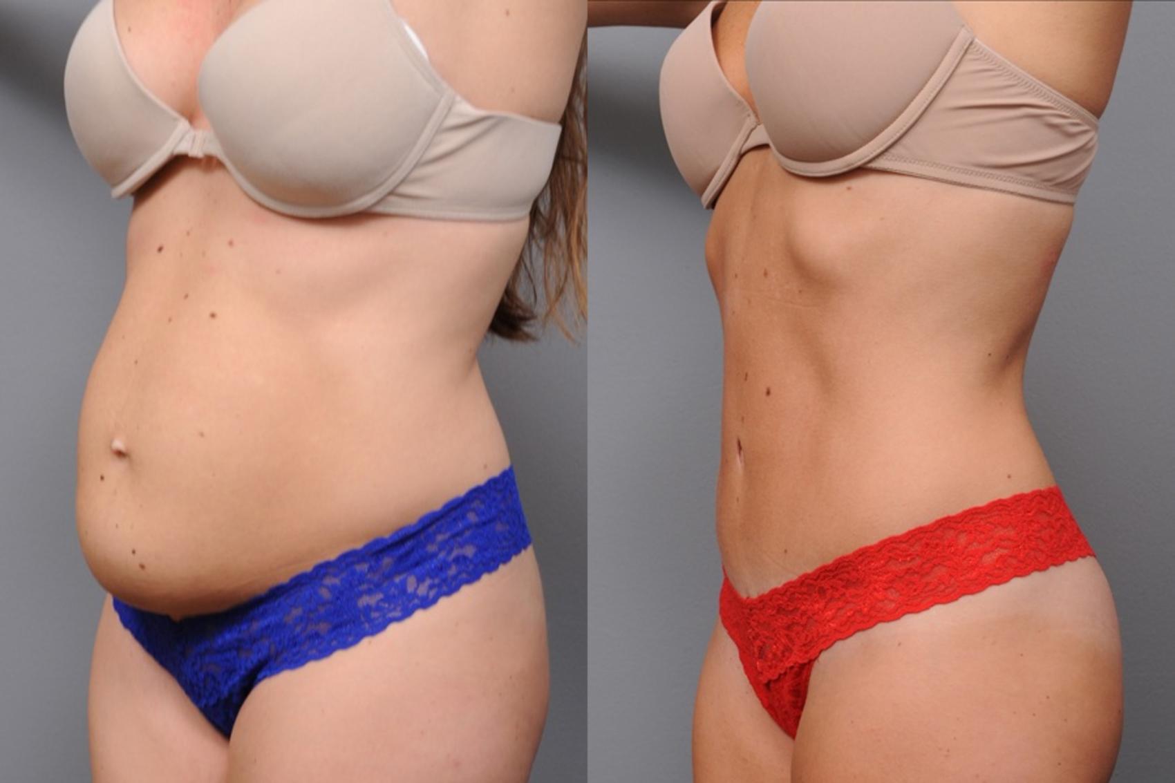 Before & After Tummy Tuck Case 64 View #3 View in New York, NY