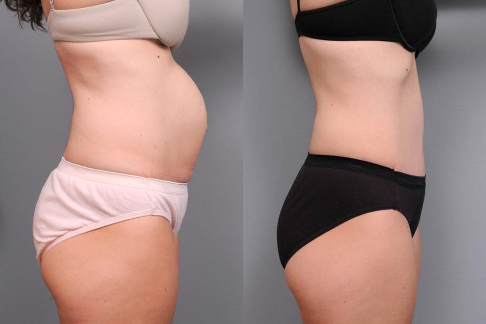 Before & After Tummy Tuck Case 65 View #1 View in New York, NY