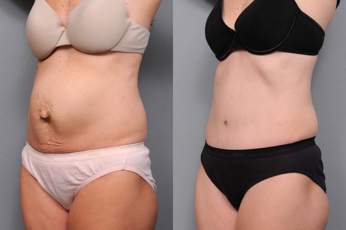 Before & After Tummy Tuck Case 65 View #2 View in New York, NY