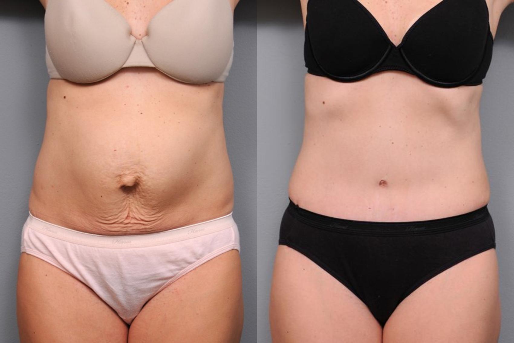 Before & After Tummy Tuck Case 65 View #3 View in New York, NY