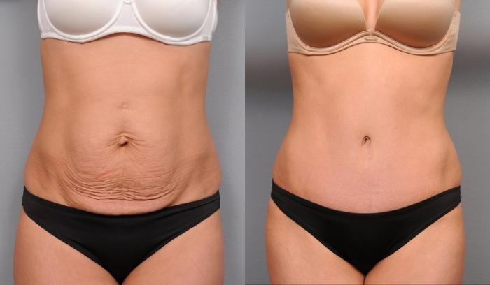 Before & After Tummy Tuck Case 68 View #1 View in New York, NY