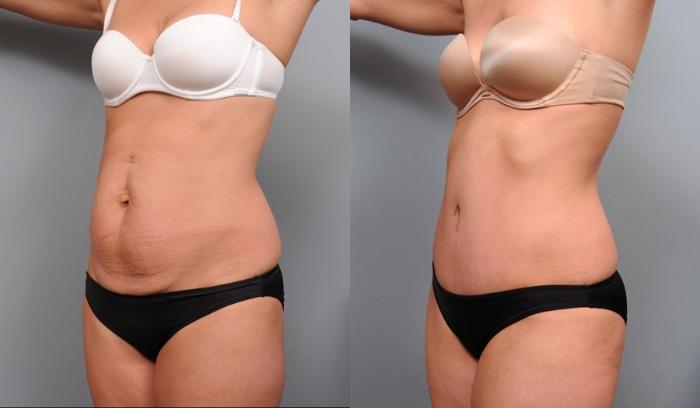 Before & After Tummy Tuck Case 68 View #2 View in New York, NY