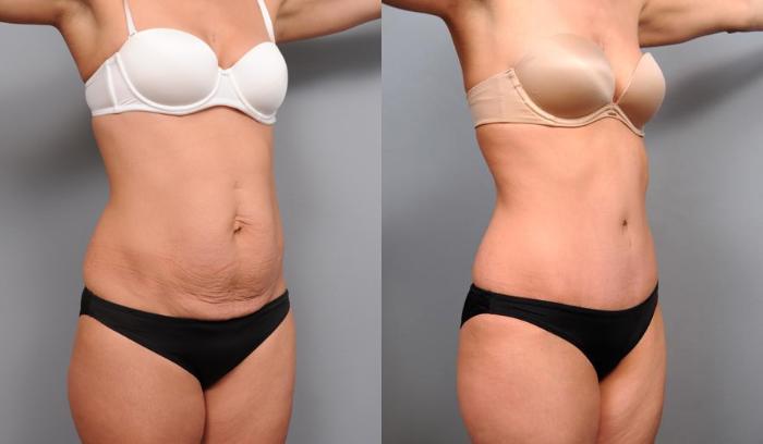 Before & After Tummy Tuck Case 68 View #4 View in New York, NY