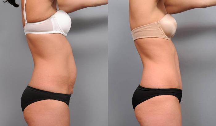 Before & After Tummy Tuck Case 68 View #5 View in New York, NY
