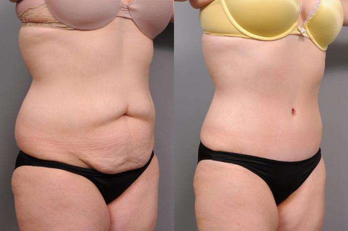 Before & After Tummy Tuck Case 69 View #2 View in New York, NY