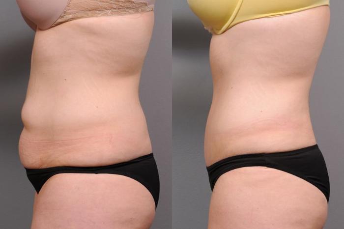 Before & After Tummy Tuck Case 69 View #3 View in New York, NY