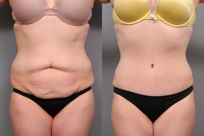 Before & After Tummy Tuck Case 69 View #4 View in New York, NY