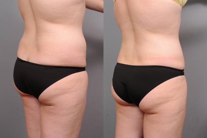 Before & After Tummy Tuck Case 69 View #5 View in New York, NY