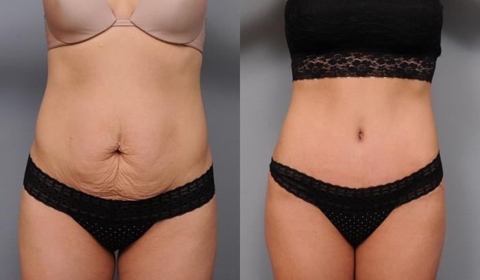 Before & After Tummy Tuck Case 70 View #1 View in New York, NY
