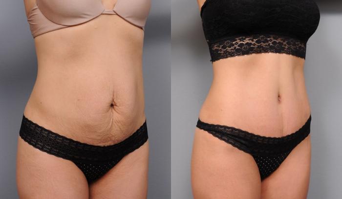 Before & After Tummy Tuck Case 70 View #2 View in New York, NY