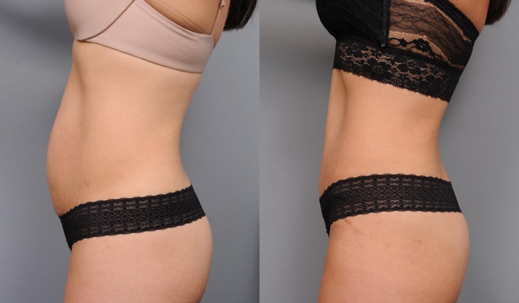 Before & After Tummy Tuck Case 70 View #3 View in New York, NY