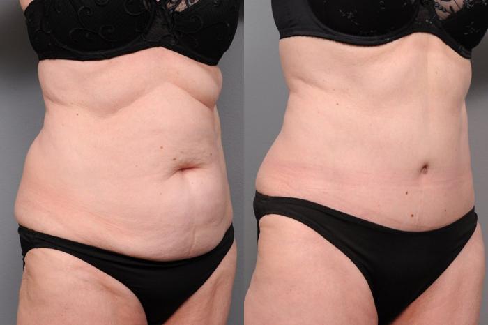 Before & After Tummy Tuck Case 71 View #2 View in New York, NY