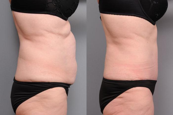 Before & After Tummy Tuck Case 71 View #3 View in New York, NY