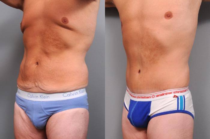Before & After Tummy Tuck Case 66 View #1 View in New York, NY
