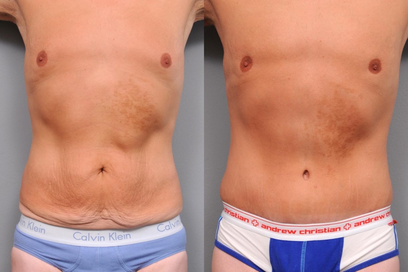 Before & After Tummy Tuck for Men Case 66 View #2 View in New York, NY