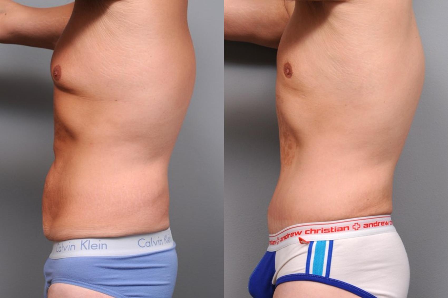 Before & After Tummy Tuck for Men Case 66 View #3 View in New York, NY