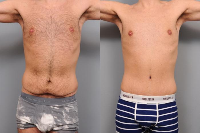 Before & After Tummy Tuck for Men Case 67 View #1 View in New York, NY