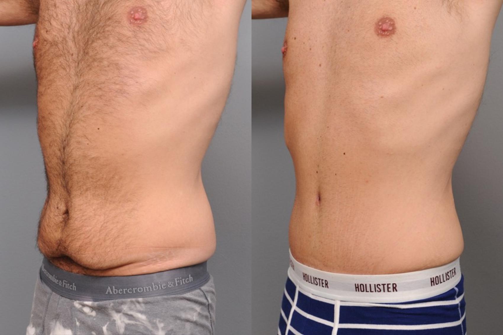 Before & After Tummy Tuck for Men Case 67 View #2 View in New York, NY