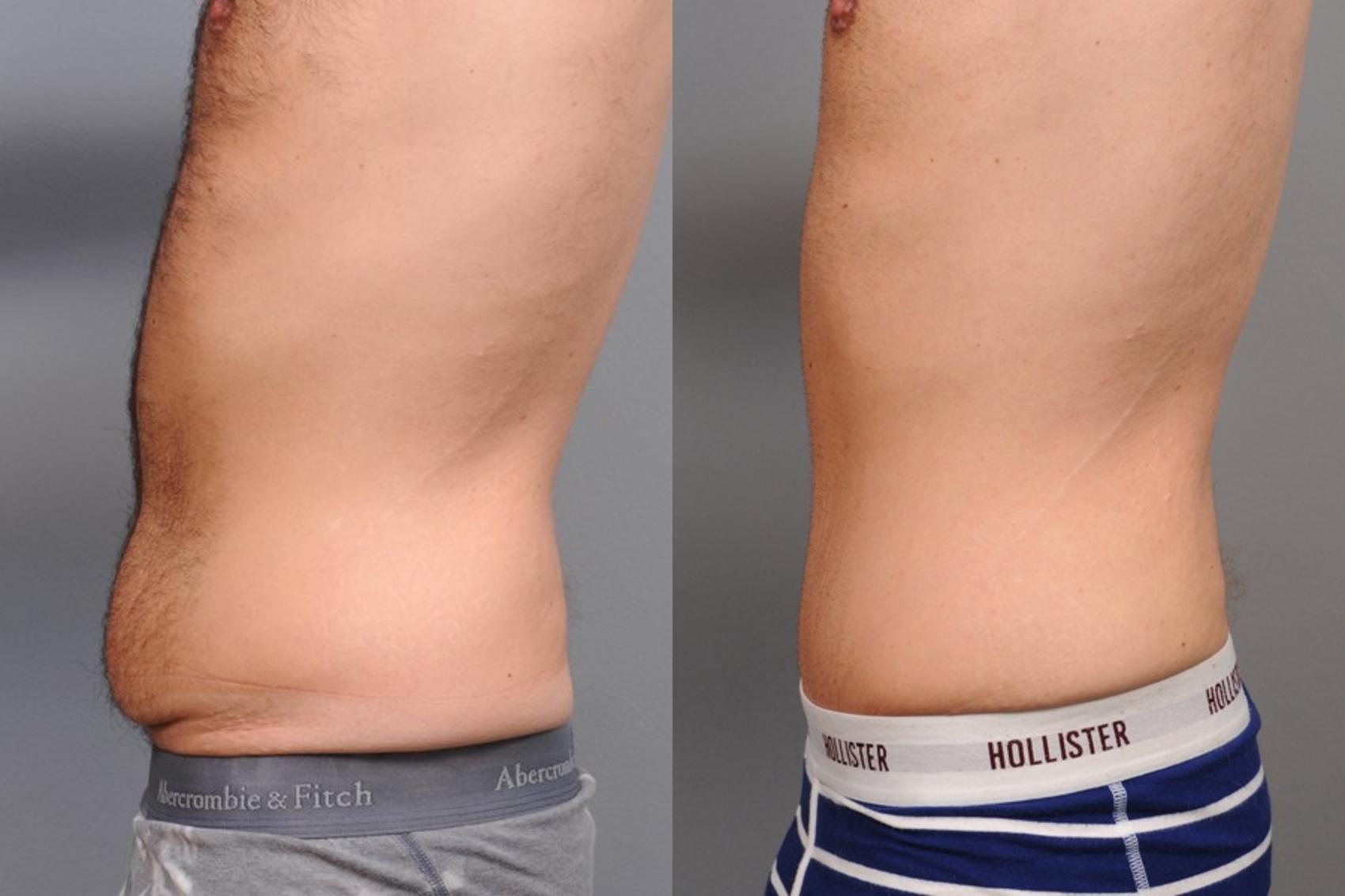 Before & After Tummy Tuck for Men Case 67 View #3 View in New York, NY